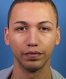 African American Rhinoplasty