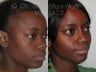African American Rhinoplasty