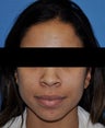 African American Rhinoplasty