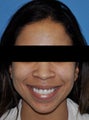 African American Rhinoplasty