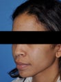 African American Rhinoplasty