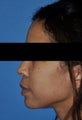 African American Rhinoplasty