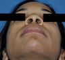 African American Rhinoplasty