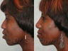 African American Rhinoplasty