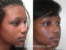 African American Rhinoplasty