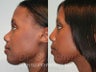 African American Rhinoplasty