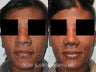 African American Rhinoplasty