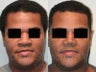 African American Rhinoplasty