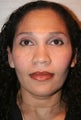 African American Rhinoplasty