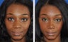 African American Ethnic Rhinoplasty