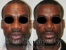 Ethnic-African American Rhinoplasty
