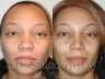 African American Rhinoplasty