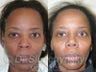 African American Rhinoplasty