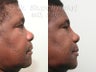 Ethnic Rhinoplasty