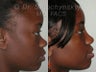 African American Rhinoplasty