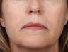Alex Laser for Brown Spots on Face