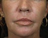 C02 Results on Aging Female Face