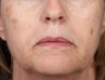 Alex Laser for Brown Spots on Face