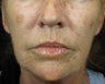 C02 Results on Aging Female Face