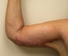 Brachioplasty