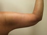 Brachioplasty