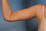 Arm Lift