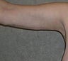 Arm Lift (Brachioplasty)