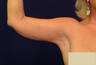 Arm Lift