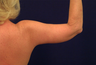 Arm Lift