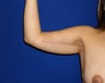 Arm lift