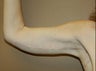 arm tuck