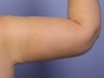 Arm Lift