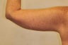 Brachioplasty (Arm Lift)