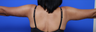 Arm Lift