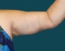 Arm Lift