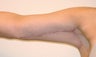 Brachioplasty (Arm Lift) After Massive Weight Loss (Front View)