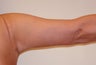 Brachioplasty (Arm Lift) After Massive Weight Loss (Posterior View)