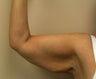 Brachioplasty
