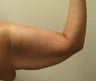Brachioplasty