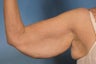 Arm Lift