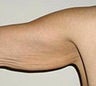 Arm Lift (Brachioplasty)