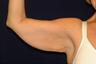 Arm Lift