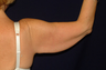 Arm Lift