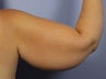 Arm Lift
