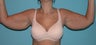 Armlift