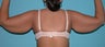 Armlift