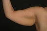 Arm Lift