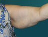 Arm Lift