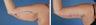 Arm Lift (Brachioplasty)