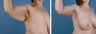 Arm lift (Brachioplasty)